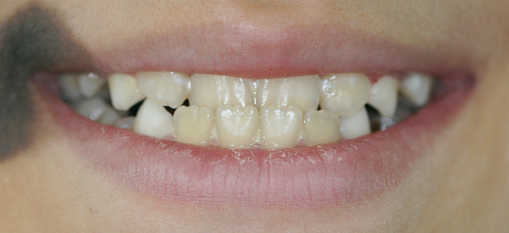 Ortopedia dentofacial antes caso 4